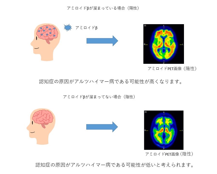 アミロイドPETの説明図1